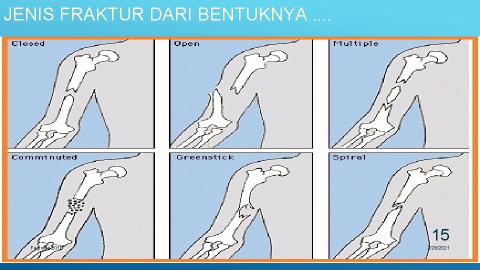 JENIS FRAKTUR DARI BENTUKNYA. . 15 Faginitra-2018 2/28/2021 