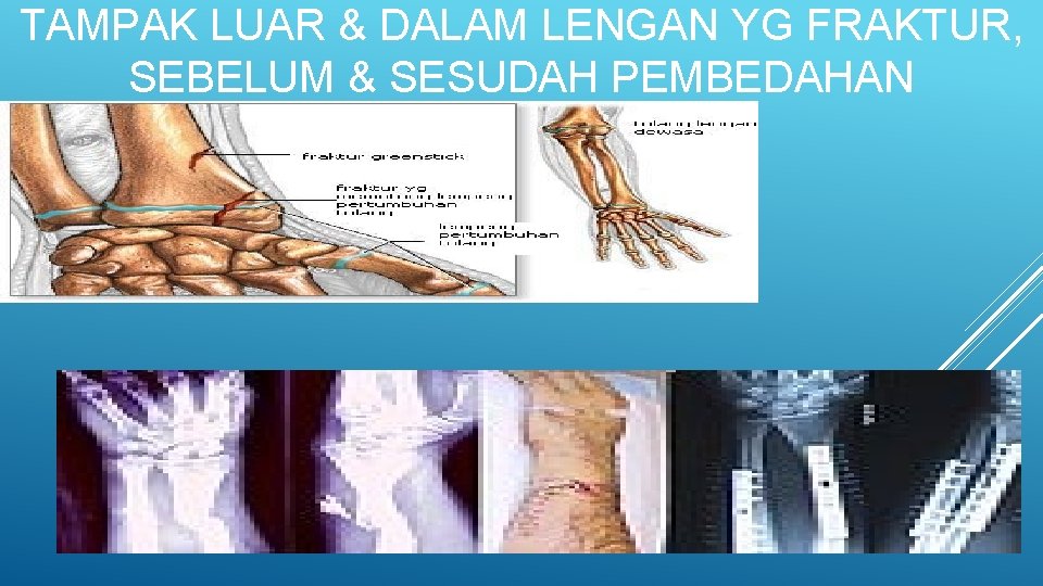 TAMPAK LUAR & DALAM LENGAN YG FRAKTUR, SEBELUM & SESUDAH PEMBEDAHAN 20 Faginitra-2018 2/28/2021