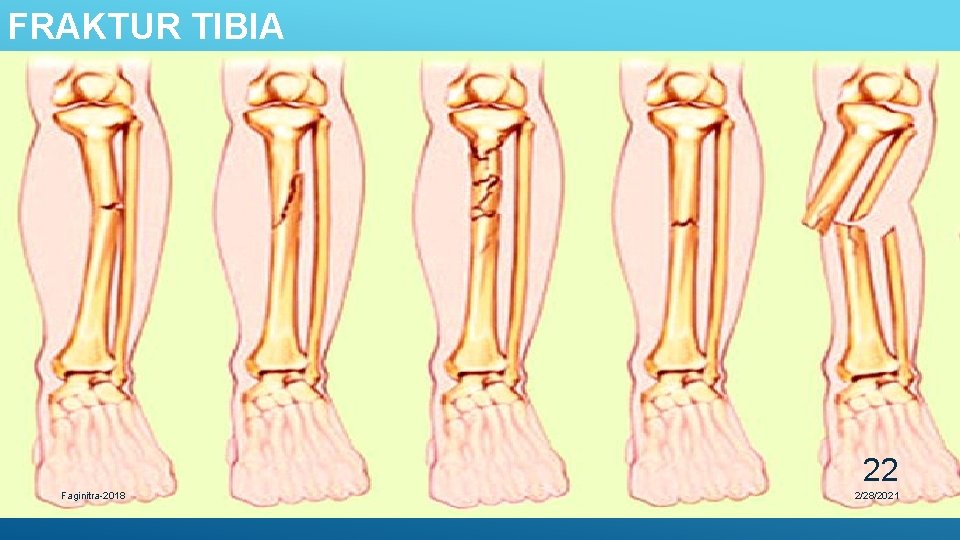FRAKTUR TIBIA 22 Faginitra-2018 2/28/2021 