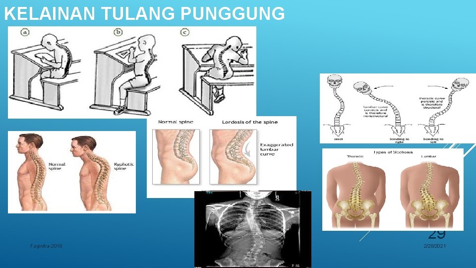 KELAINAN TULANG PUNGGUNG 29 Faginitra-2018 2/28/2021 