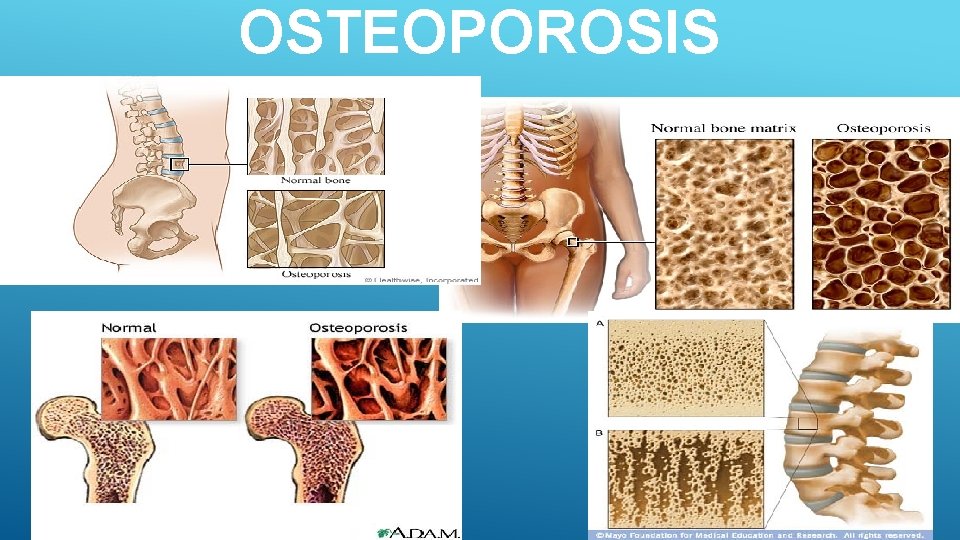 OSTEOPOROSIS 34 Faginitra-2018 2/28/2021 