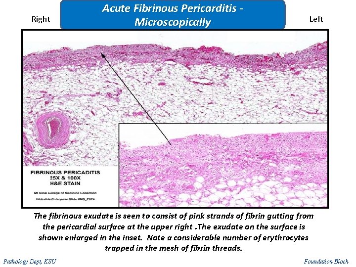 Right Acute Fibrinous Pericarditis - Microscopically Left The fibrinous exudate is seen to consist