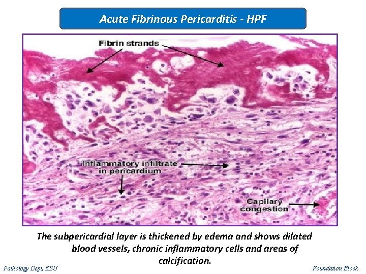 Acute Fibrinous Pericarditis - HPF The subpericardial layer is thickened by edema and shows