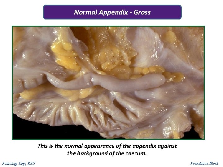 Normal Appendix - Gross This is the normal appearance of the appendix against the