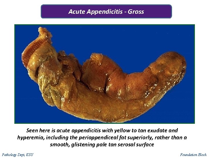 Acute Appendicitis - Gross Seen here is acute appendicitis with yellow to tan exudate