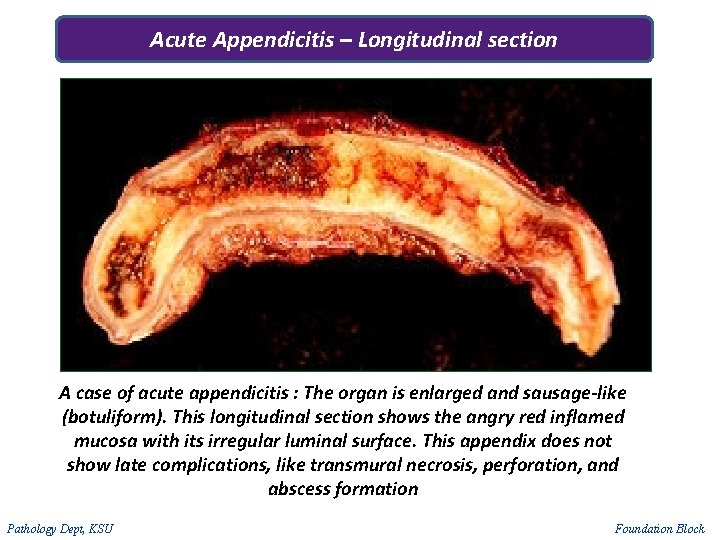 Acute Appendicitis – Longitudinal section A case of acute appendicitis : The organ is