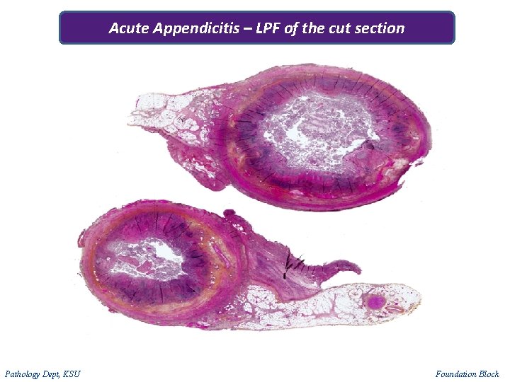 Acute Appendicitis – LPF of the cut section Pathology Dept, KSU Foundation Block 