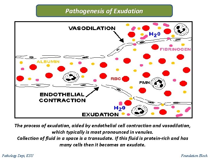 Pathogenesis of Exudation The process of exudation, aided by endothelial cell contraction and vasodilation,