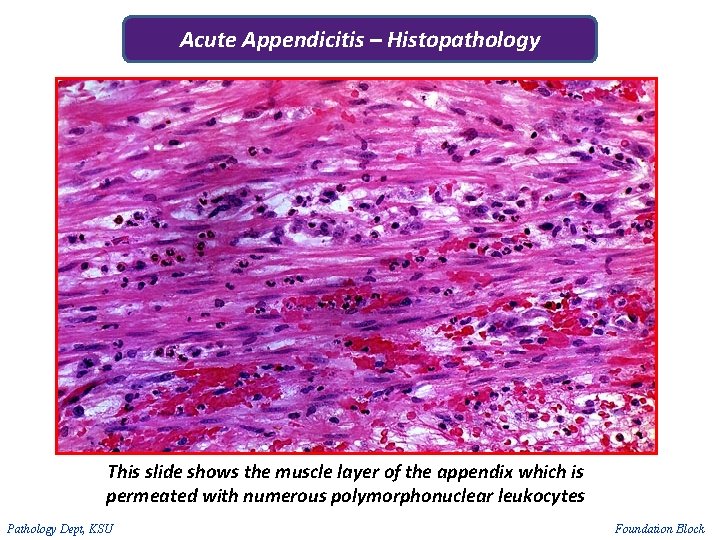 Acute Appendicitis – Histopathology This slide shows the muscle layer of the appendix which