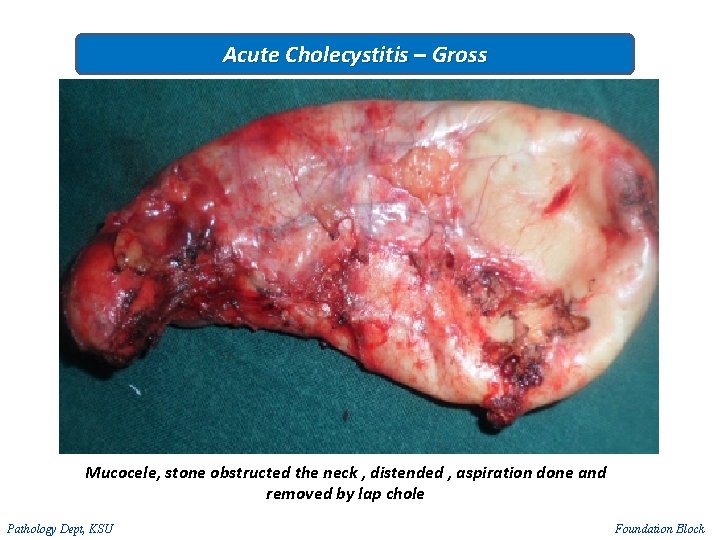 Acute Cholecystitis – Gross Mucocele, stone obstructed the neck , distended , aspiration done