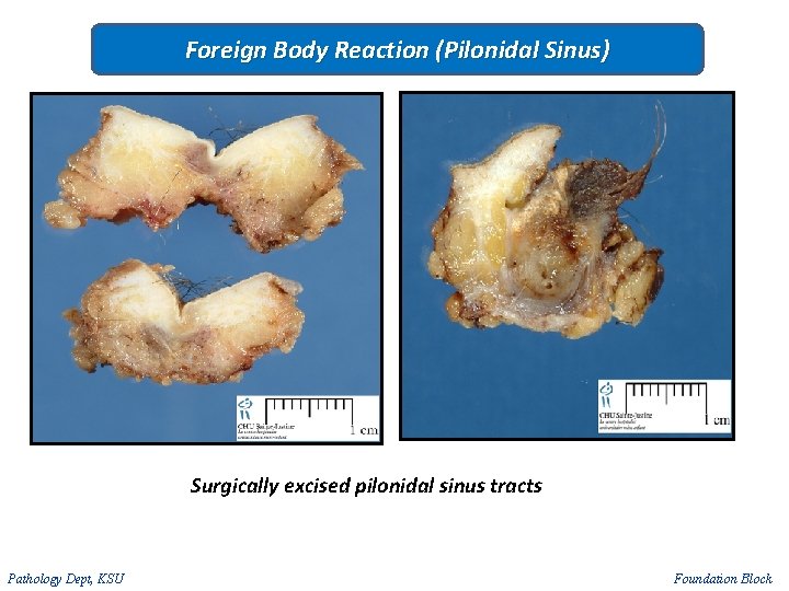 Foreign Body Reaction (Pilonidal Sinus) Surgically excised pilonidal sinus tracts Pathology Dept, KSU Foundation