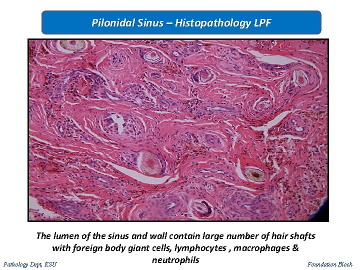 Pilonidal Sinus – Histopathology LPF The lumen of the sinus and wall contain large