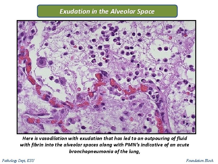 Exudation in the Alveolar Space Here is vasodilation with exudation that has led to