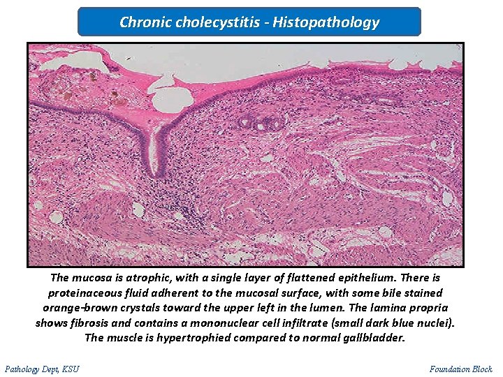 Chronic cholecystitis - Histopathology The mucosa is atrophic, with a single layer of flattened