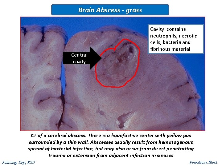 Brain Abscess - gross Central cavity Cavity contains neutrophils, necrotic cells, bacteria and fibrinous