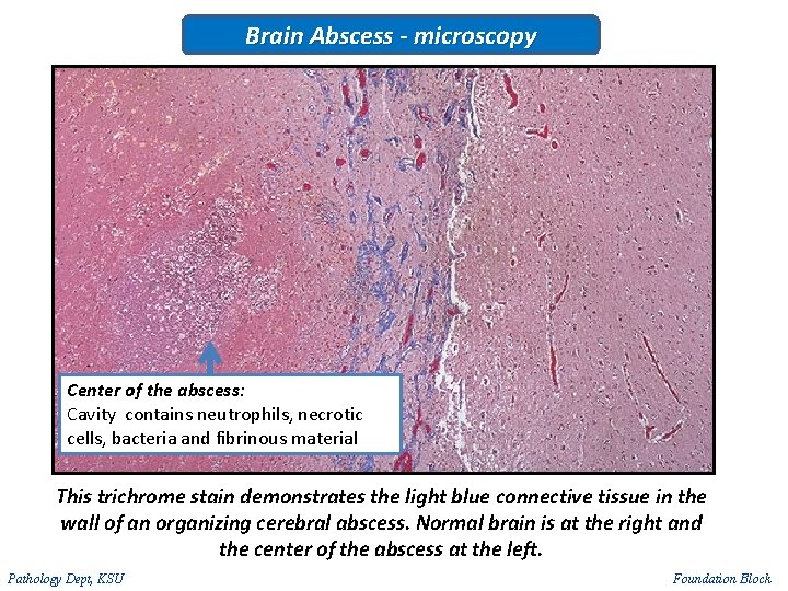 Brain Abscess - microscopy Center of the abscess: Cavity contains neutrophils, necrotic cells, bacteria