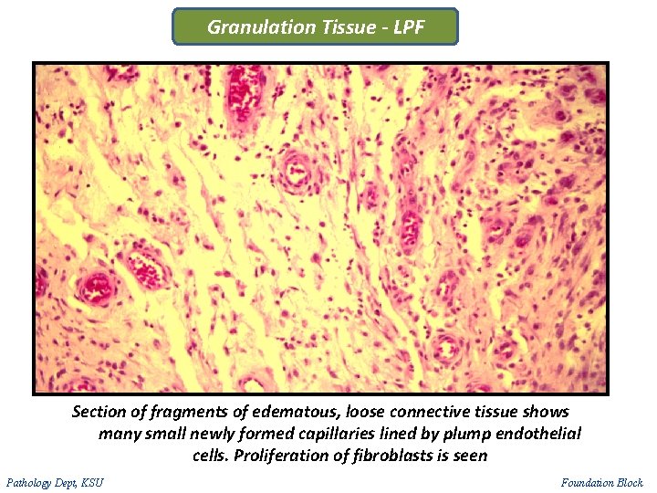 Granulation Tissue - LPF Section of fragments of edematous, loose connective tissue shows many