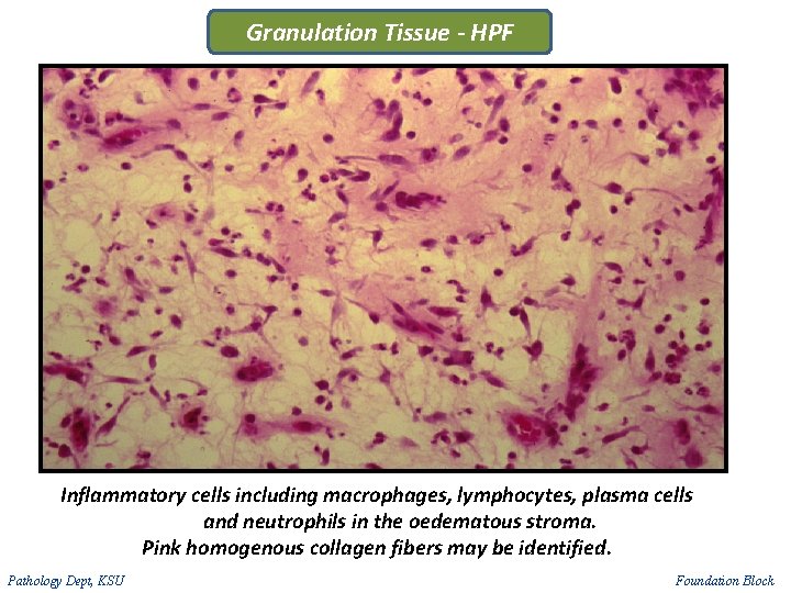 Granulation Tissue - HPF Inflammatory cells including macrophages, lymphocytes, plasma cells and neutrophils in