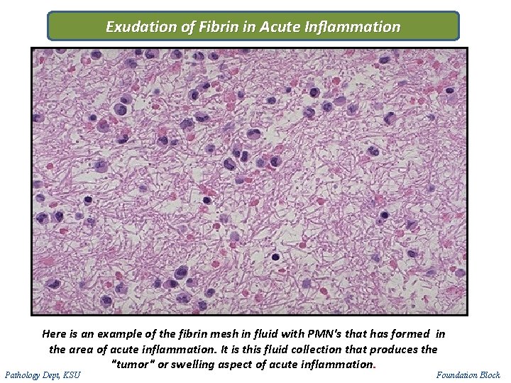 Exudation of Fibrin in Acute Inflammation Here is an example of the fibrin mesh