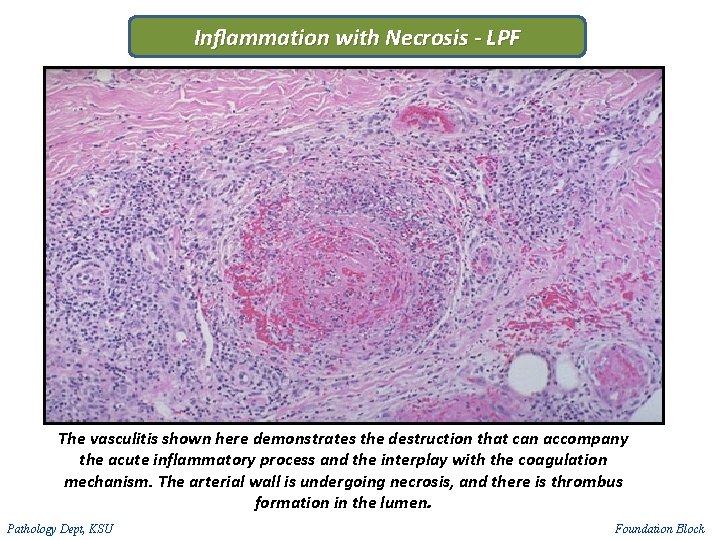 Inflammation with Necrosis - LPF The vasculitis shown here demonstrates the destruction that can