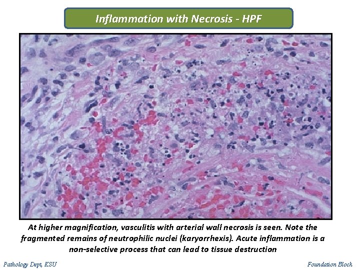 Inflammation with Necrosis - HPF At higher magnification, vasculitis with arterial wall necrosis is