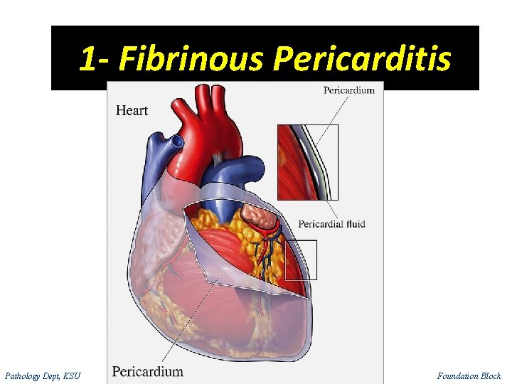 1 - Fibrinous Pericarditis Pathology Dept, KSU Foundation Block 