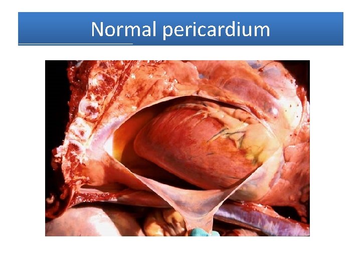 Normal pericardium 