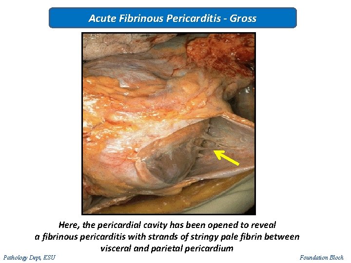 Acute Fibrinous Pericarditis - Gross Here, the pericardial cavity has been opened to reveal