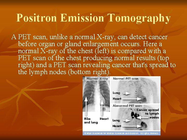 Positron Emission Tomography A PET scan, unlike a normal X-ray, can detect cancer before