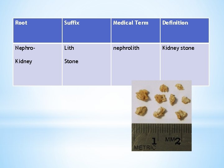 Root Suffix Medical Term Definition Nephro- Lith nephrolith Kidney stone Kidney Stone 