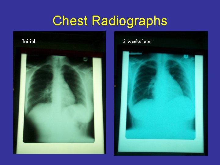 Chest Radiographs Initial 3 weeks later 