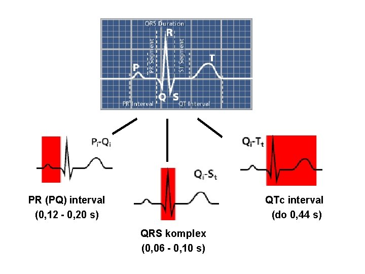 PR (PQ) interval (0, 12 - 0, 20 s) QTc interval (do 0, 44