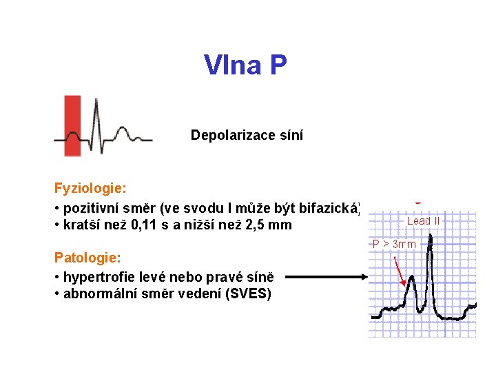 Vlna P Depolarizace síní Fyziologie: • pozitivní směr (ve svodu I může být bifazická)