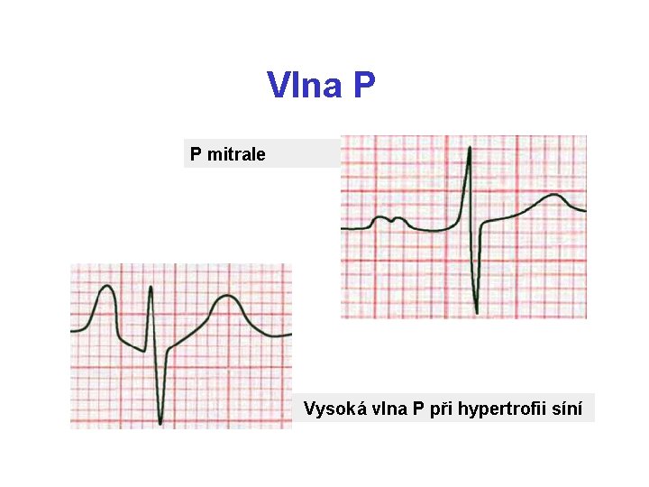 Vlna P P mitrale Vysoká vlna P při hypertrofii síní 