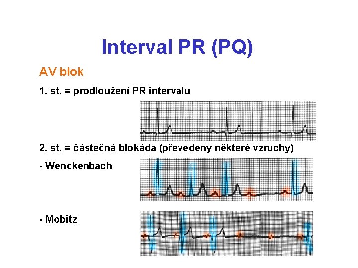 Interval PR (PQ) AV blok 1. st. = prodloužení PR intervalu 2. st. =