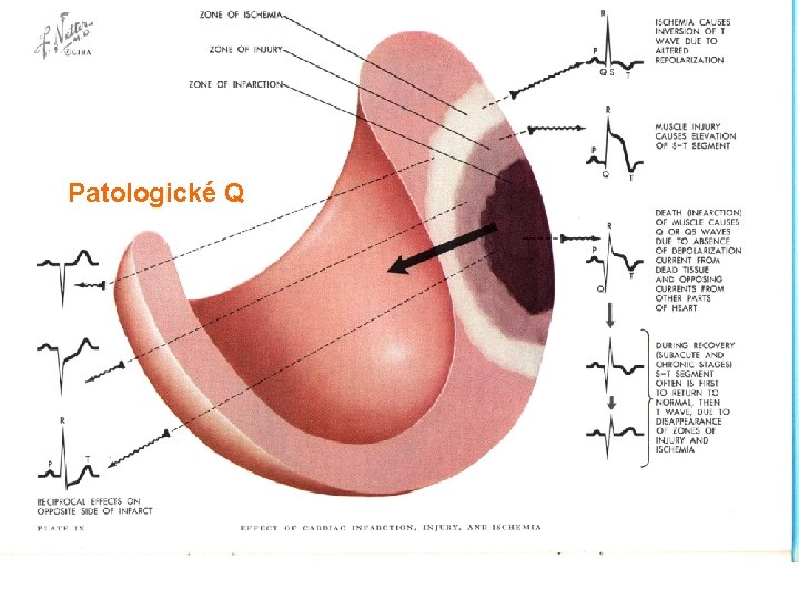 Patologické Q 