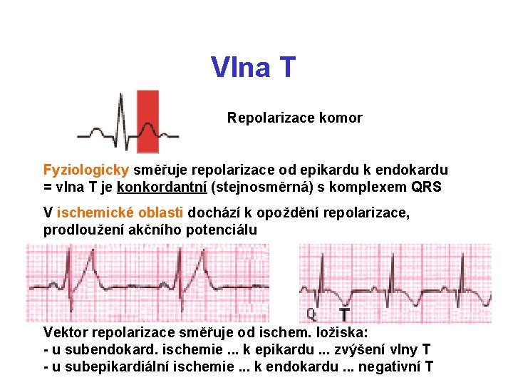 Vlna T Repolarizace komor Fyziologicky směřuje repolarizace od epikardu k endokardu = vlna T