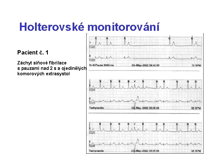 Holterovské monitorování Pacient č. 1 Záchyt síňové fibrilace s pauzami nad 2 s a