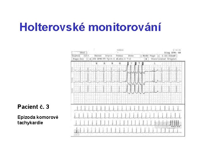 Holterovské monitorování Pacient č. 3 Epizoda komorové tachykardie 