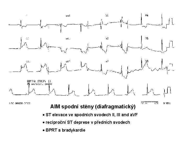 AIM spodní stěny (diafragmatický) · ST elevace ve spodních svodech II, III and a.