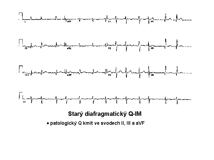 Starý diafragmatický Q-IM · patologický Q kmit ve svodech II, III a a. VF Starý diafragmatický Q-IM · patologický Q kmit ve svodech II, III a a. VF