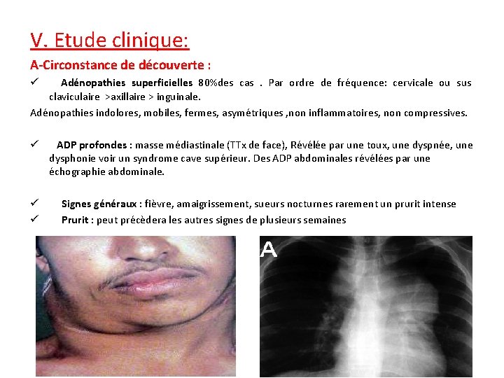 V. Etude clinique: A-Circonstance de découverte : Adénopathies superficielles 80%des cas . Par ordre