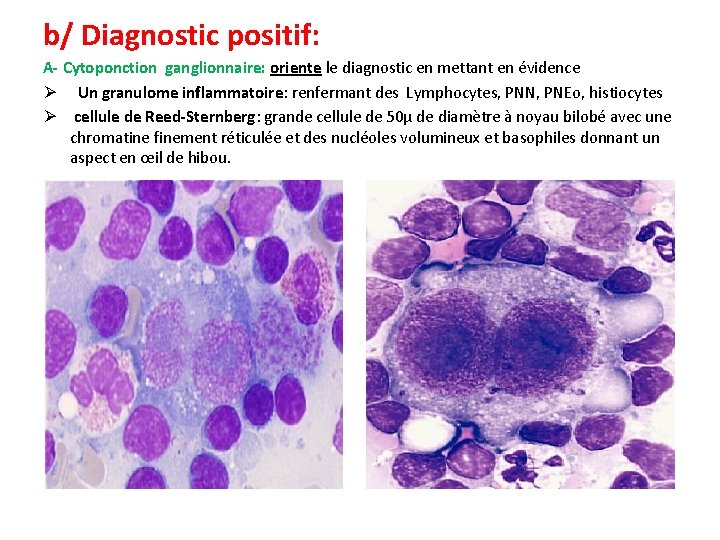 b/ Diagnostic positif: A- Cytoponction ganglionnaire: oriente le diagnostic en mettant en évidence Ø