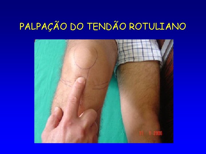 PALPAÇÃO DO TENDÃO ROTULIANO 