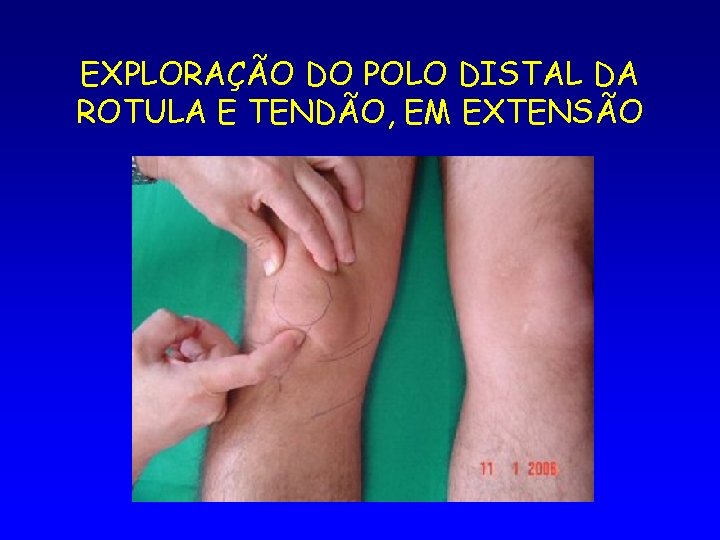 EXPLORAÇÃO DO POLO DISTAL DA ROTULA E TENDÃO, EM EXTENSÃO 