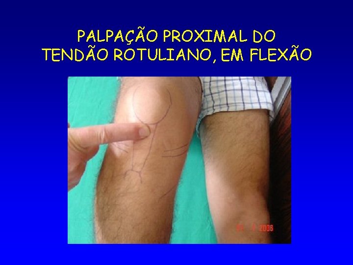 PALPAÇÃO PROXIMAL DO TENDÃO ROTULIANO, EM FLEXÃO 