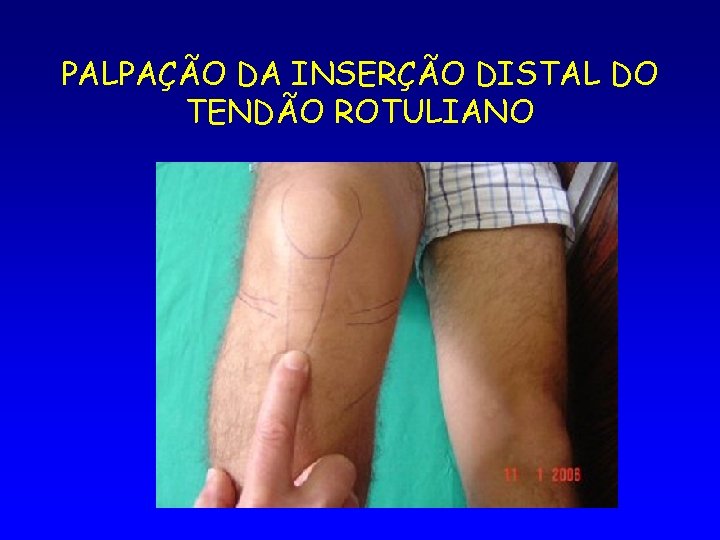 PALPAÇÃO DA INSERÇÃO DISTAL DO TENDÃO ROTULIANO 
