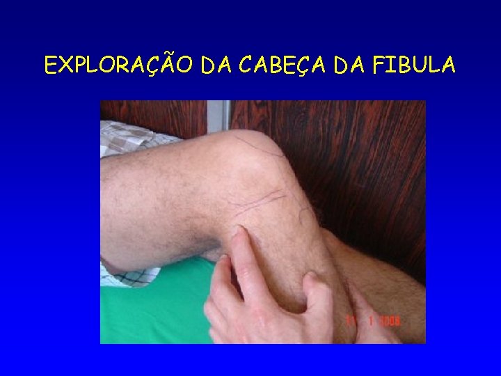EXPLORAÇÃO DA CABEÇA DA FIBULA 