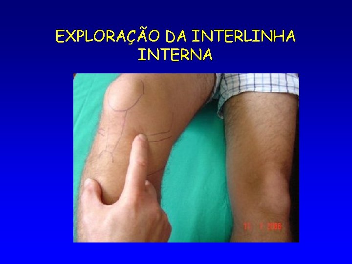 EXPLORAÇÃO DA INTERLINHA INTERNA 