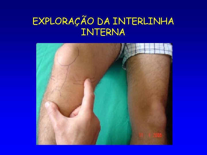 EXPLORAÇÃO DA INTERLINHA INTERNA 